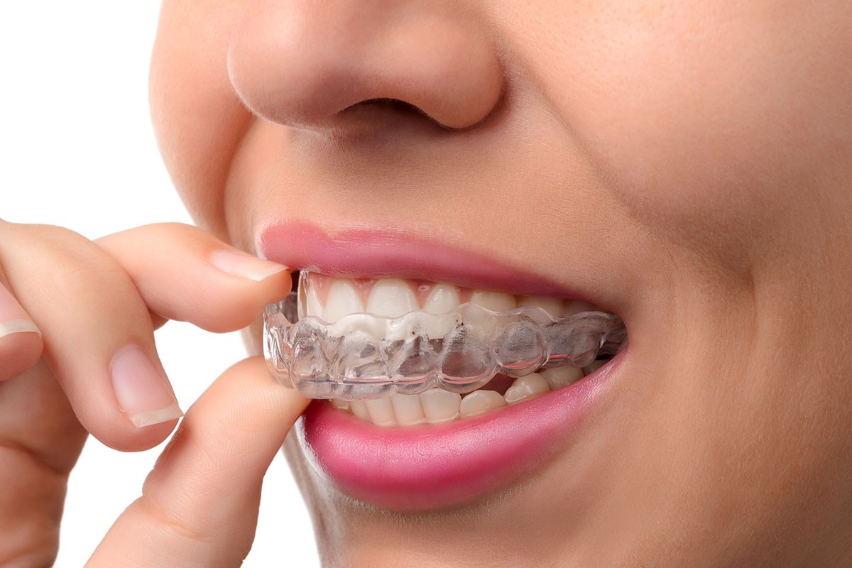 invisalign-ortodoncia-dentista